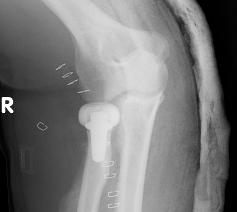 Radial Head Replacement AP